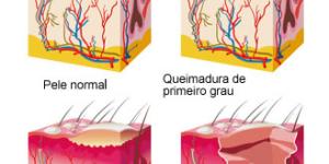 Como saber se uma queimadura está infectada