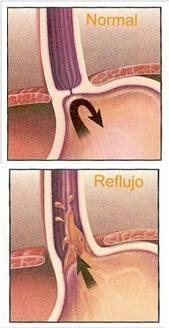 Por que tenho azia - Por que tenho azia: refluxo gastroesofágico