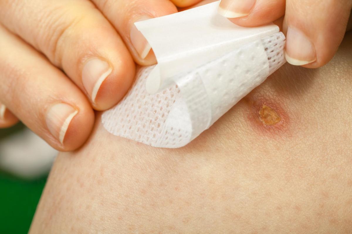 Remédios caseiros para cicatrizes queloides