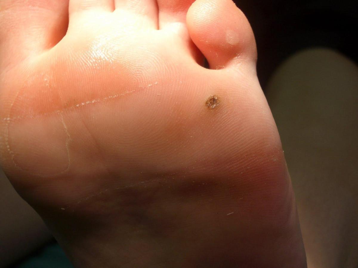 Como prevenir verrugas nos pés