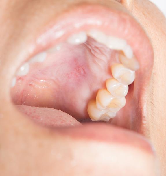Como tratar inflamação no céu da boca