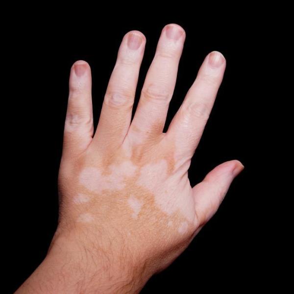 O vitiligo é hereditário? - Tipos de vitiligo