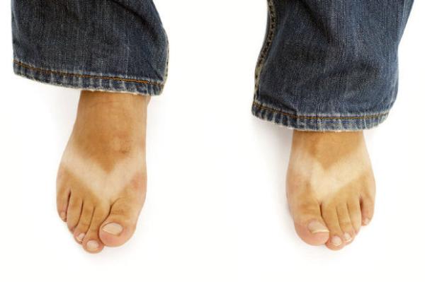 Como tirar marca de chinelo do pé