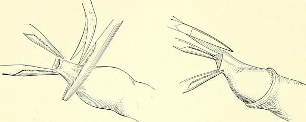 O que é ser circuncidado - Possíveis complicações da circuncisão