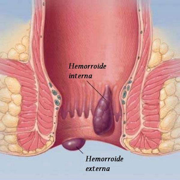 Quais são os sintomas das hemorroidas
