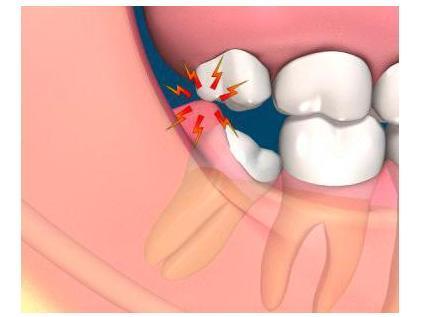 Cuidados após a extração do dente do siso - A extração do dente do siso dói?