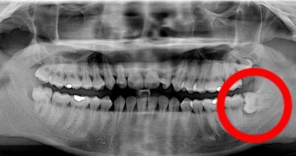 Cuidados após a extração do dente do siso