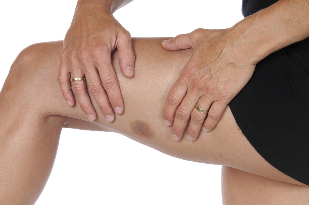 Por que tenho manchas roxas nas pernas? - Causas comuns e raras