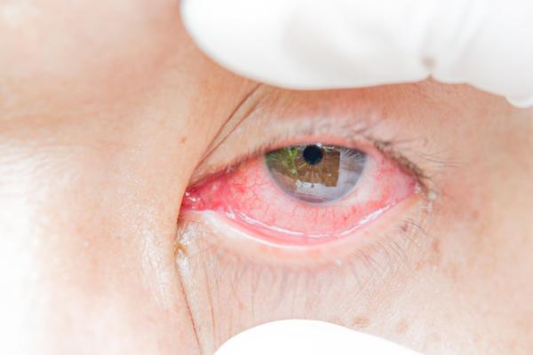 Sensação de areia nos olhos: o que fazer