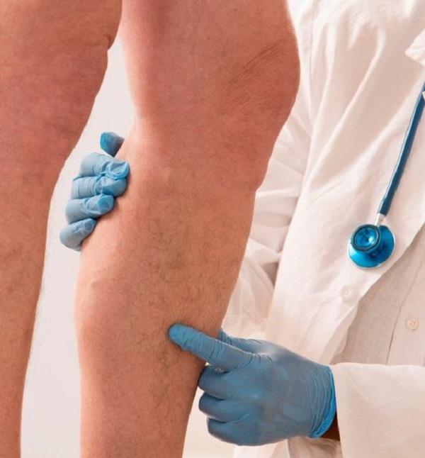 É normal aparecer caroços após cirurgia de varizes?