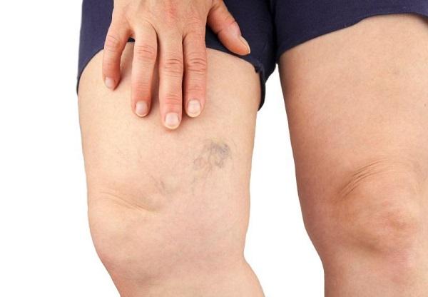 É normal aparecer caroços após cirurgia de varizes? - Pós-operatório de cirurgia de varizes 