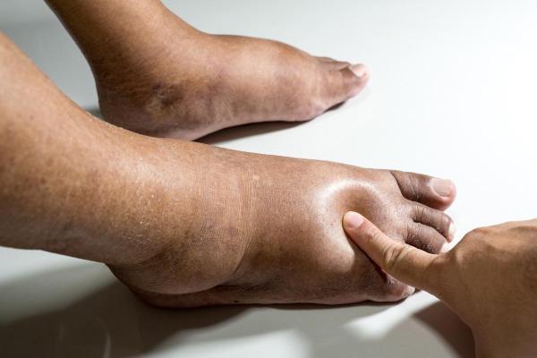 Por que os pés incham? - Edema