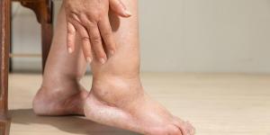 Por que os pés incham?
