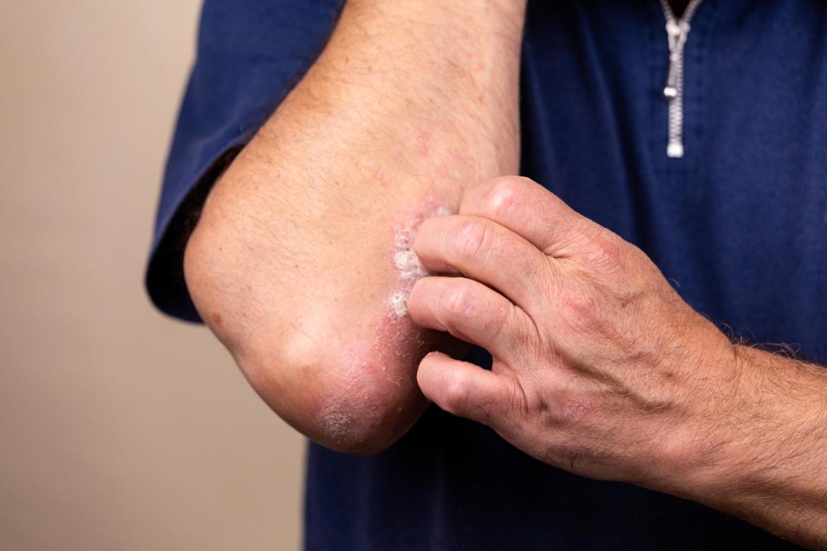 Dermatite atópica: tratamentos caseiros