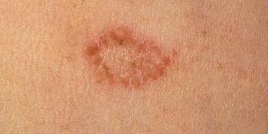 Como tratar um eczema com pasta de açafrão em pó e Neem
