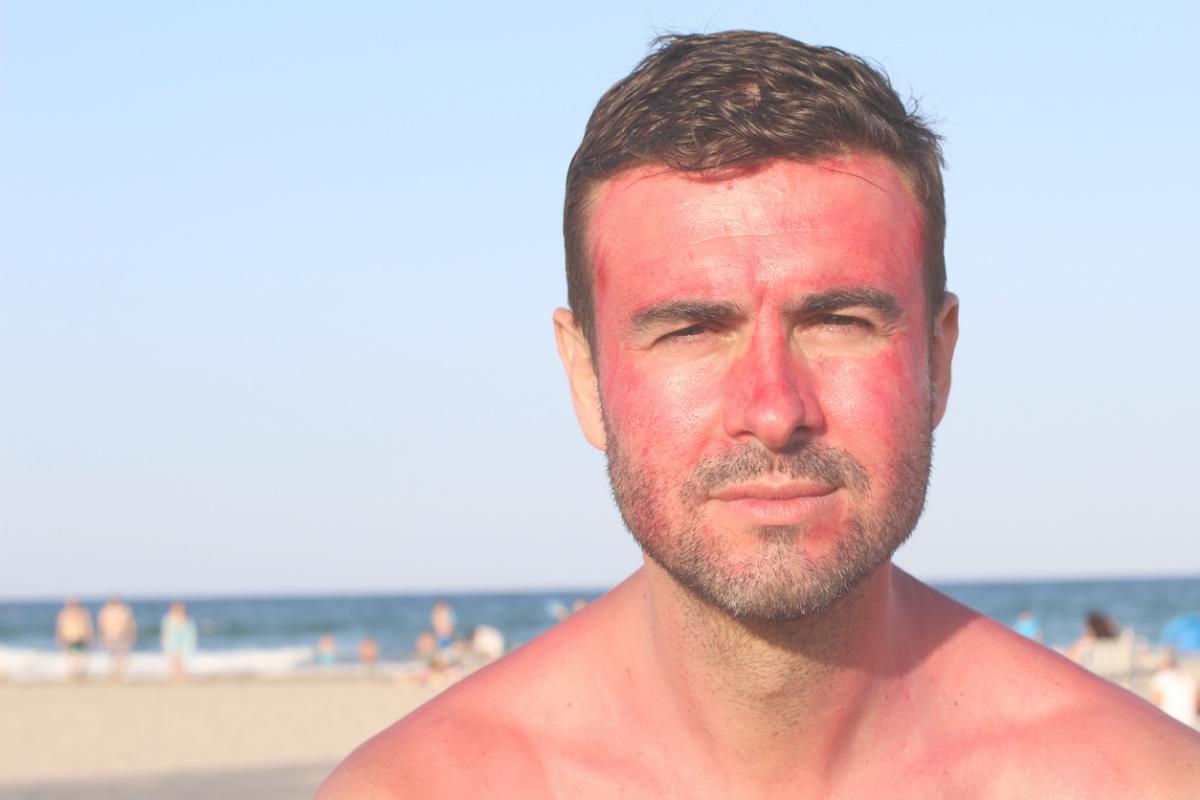 Como tirar queimadura de sol do rosto