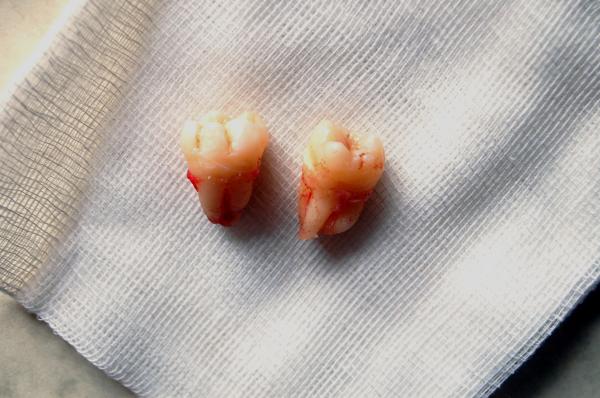 Como escovar os dentes após extração do siso