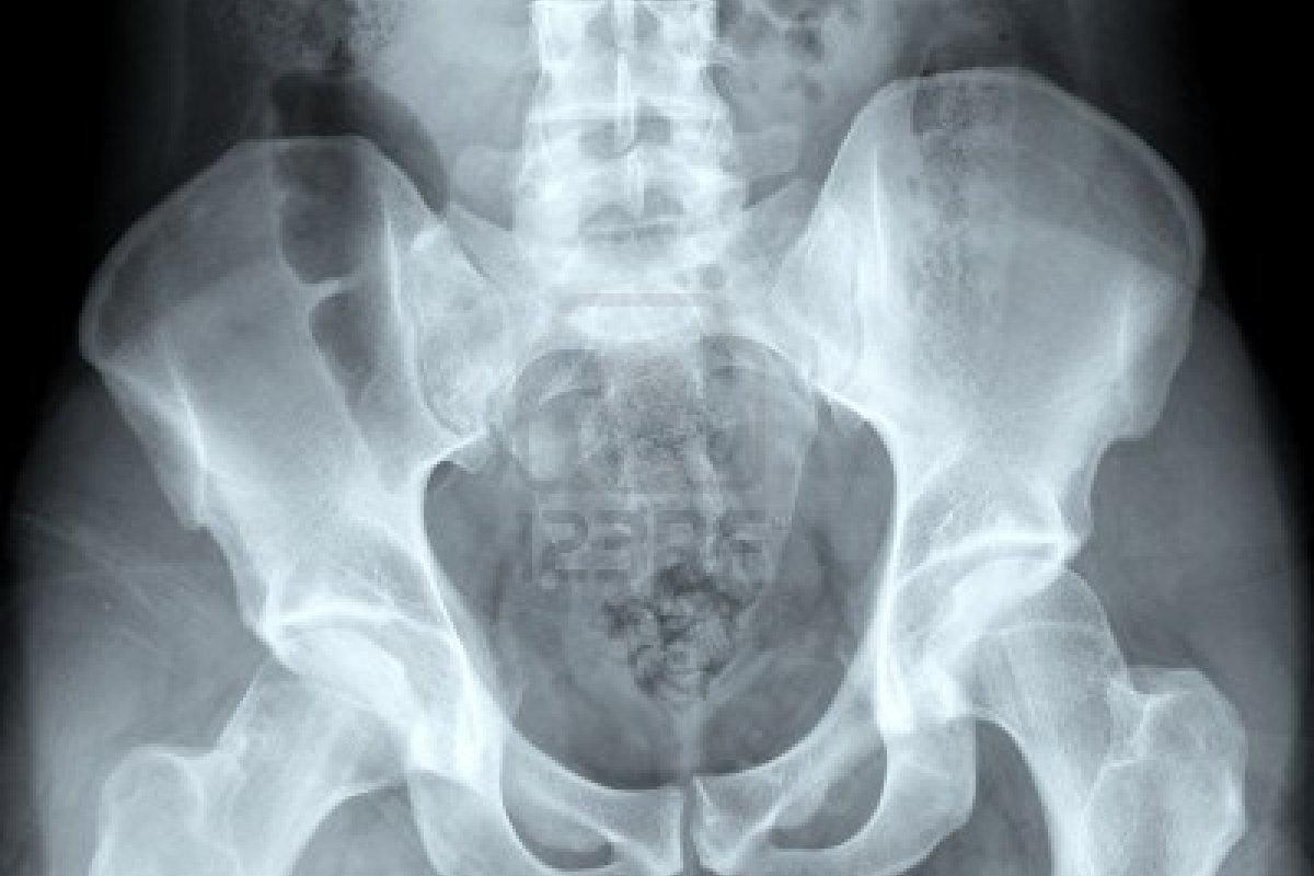 O que é esclerose óssea