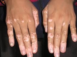 É possível curar o vitiligo com aloe? - Passo 3