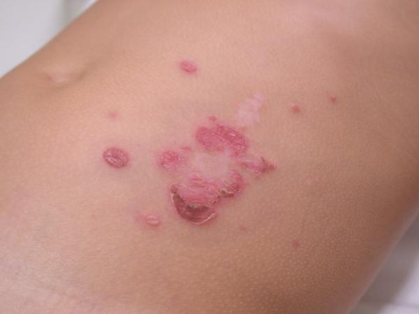 Impetigo - Causas, Sintomas e Tratamentos - Causas