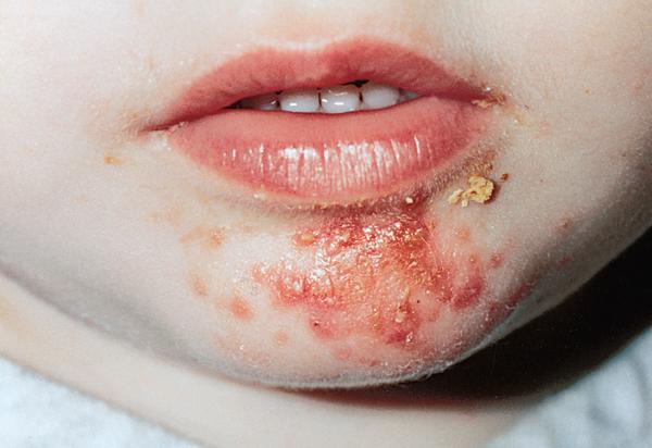 Impetigo - Causas, Sintomas e Tratamentos