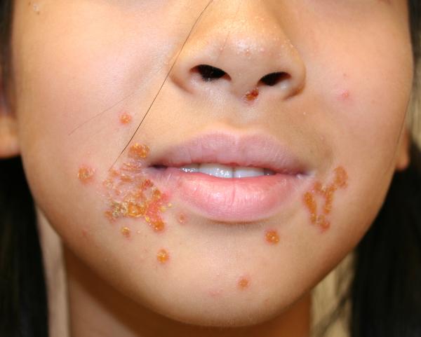Impetigo - Causas, Sintomas e Tratamentos - Tipos de Impetigo e sintomas
