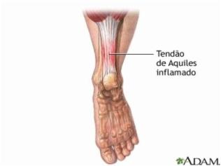 Porque o meu calcanhar dói - Inflamação do calcanhar de Aquiles