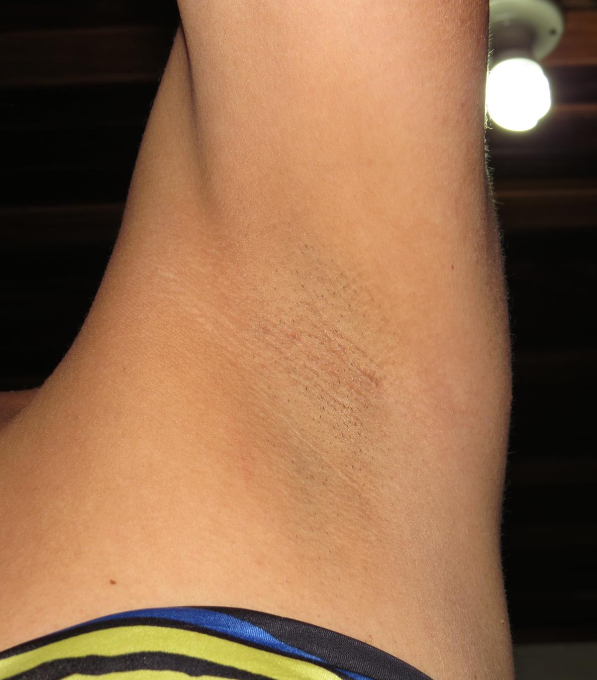 Coceira nas axilas, o que pode ser? - Problemas comuns