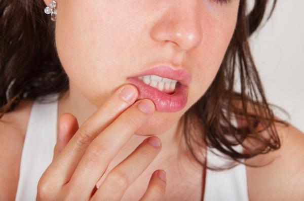 Como tratar o herpes labial com remédios caseiros