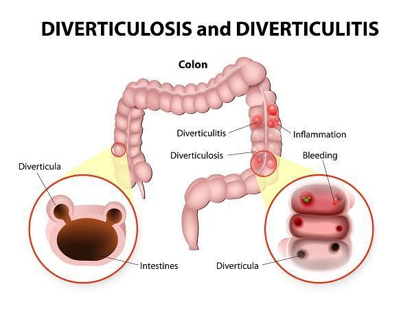 Remédios caseiros para a diverticulite - Causas e sintomas da diverticulite