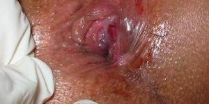 Como curar uma fissura retal - sem cirurgia