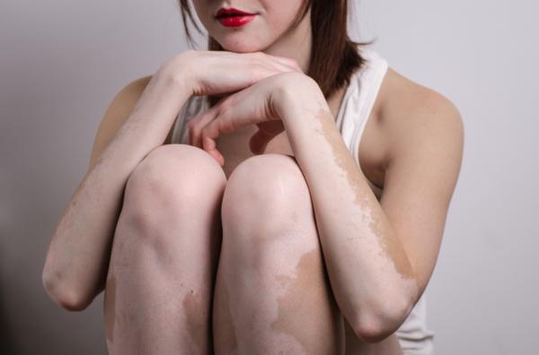 O que pode ser mancha branca na pele - O vitiligo