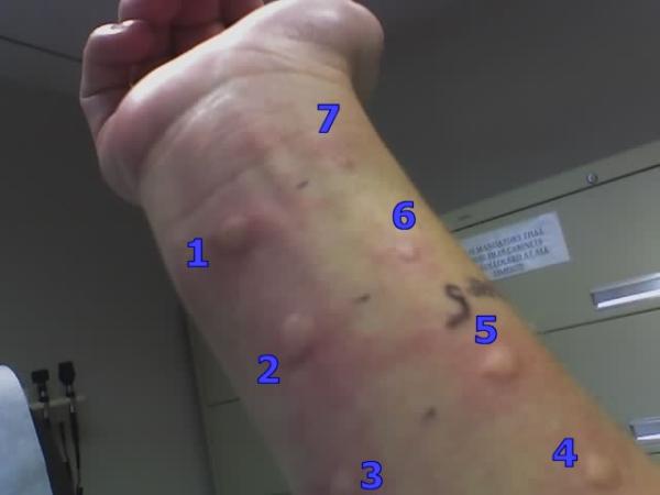Coceira no corpo, o que pode ser? - Causas mais prováveis - Coceira na pele por alergia