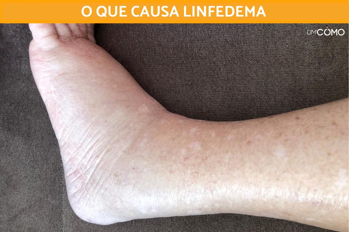 O que causa linfedema