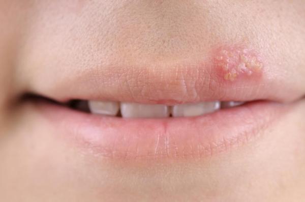 Como evitar o herpes labial