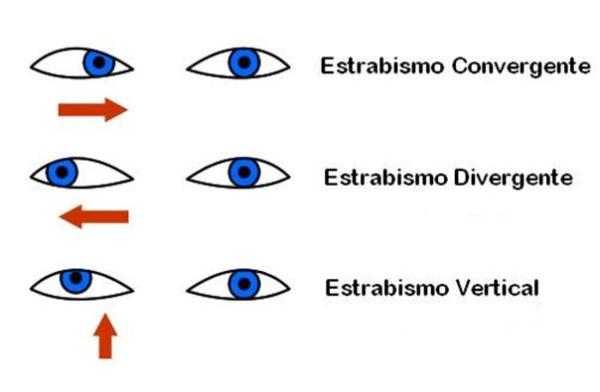 Como identificar estrabismo no bebê - Passo 3