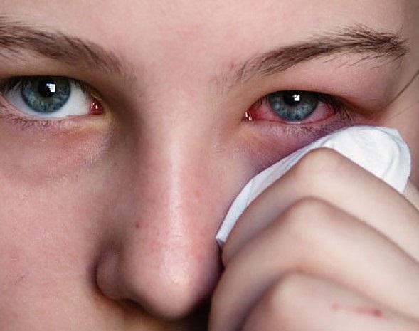 Remédios caseiros para os olhos vermelhos
