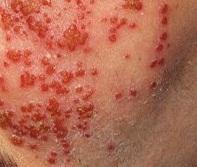 Como se livrar naturalmente do eczema de ouvido