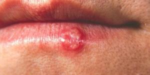 Como aumentar a imunidade contra herpes - técnicas naturais!