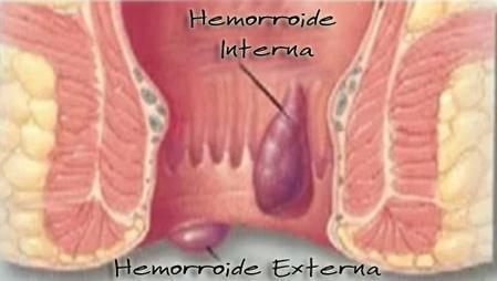 Tipos de hemorroidas com fotos - Hemorroidas Internas
