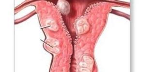 Quais são os sintomas de um mioma uterino