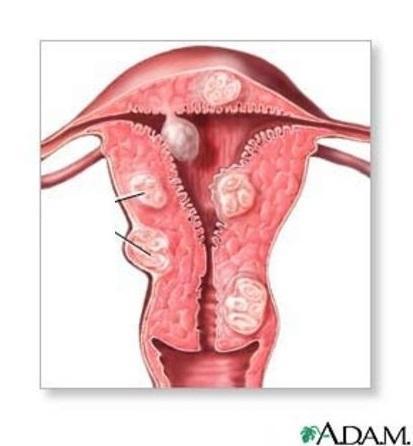 Quais são os sintomas de um mioma uterino