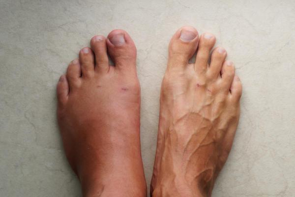 Pé inchado no calor: por que acontece e como tratar - Por que o pé incha no calor?