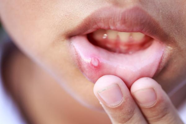 Como se pega HPV na boca