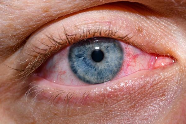 Pessoas que dormem com os olhos abertos: por que acontece? - Sintomas e problemas de dormir com os olhos abertos