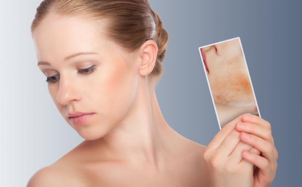Como tratar dermatite perioral