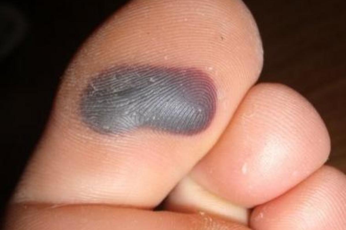 Como tratar uma bolha de sangue