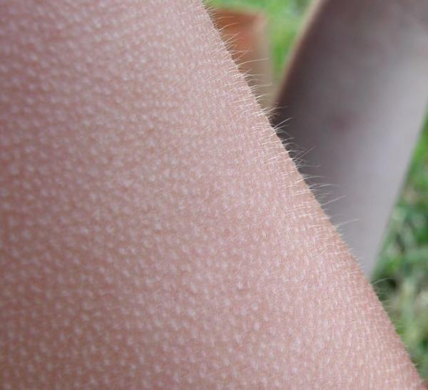 Quais são as camadas da pele - Funções e anexos - Epiderme