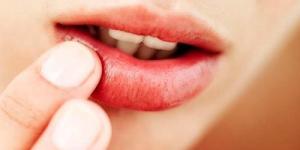 Como curar um herpes labial